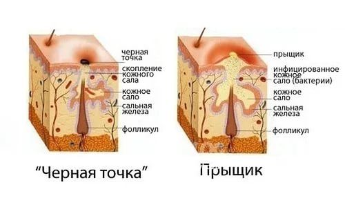 Рецепты красоты или как не иметь на лице ни 1 черной точки(Очень много полезных букв)С тапками на выход!)))