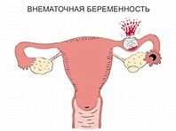 Месячные со сгустками-норма или патология?