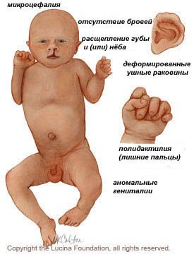 Синдром Патау