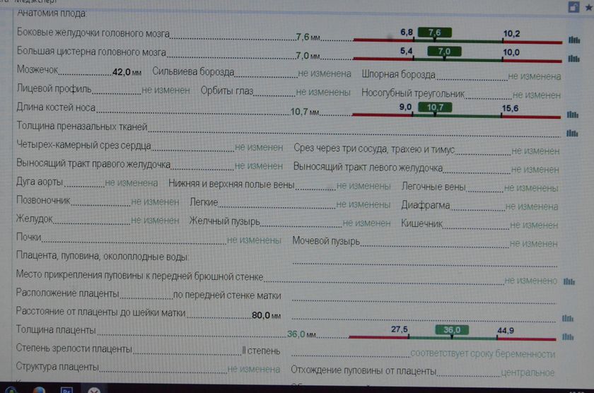 Узи 34 Недели 3 дня...фото