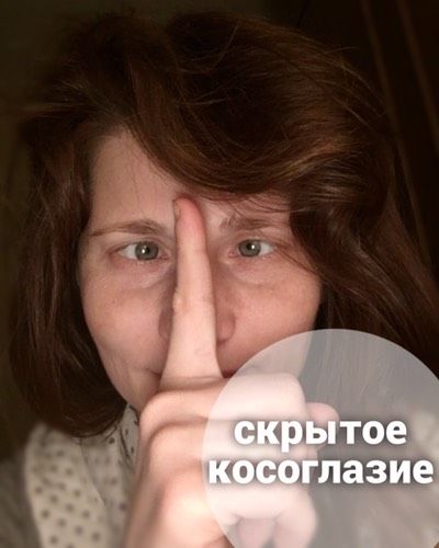 Скрытое косоглазие (экзофория)