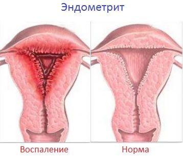 Опасные сроки при беременности