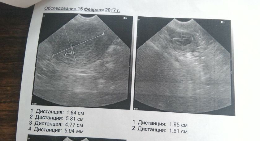 Первое УЗИ!
