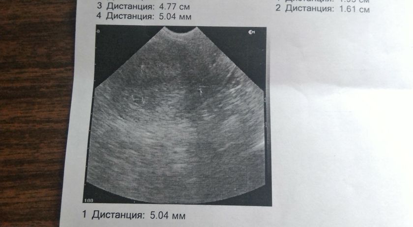 Первое УЗИ!