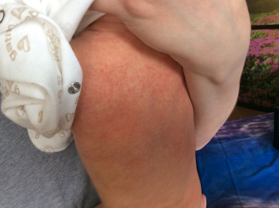 Диагностика аллергии у ребенка в 1 мес